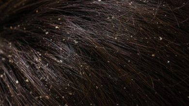 Photo of وداعا لقشرة الشعر.. 9 علاجات منزلية طبيعية